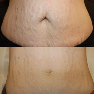 Before And After Morpheus8 Therapy For Stretch Marks