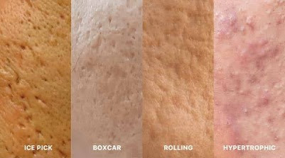 Visual Representation Of How Acne Scars Develop On The Skin.