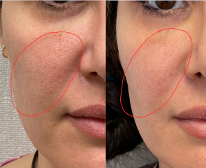 Morpheus8 Treatment Before And After To Female Patient With Acne Scars