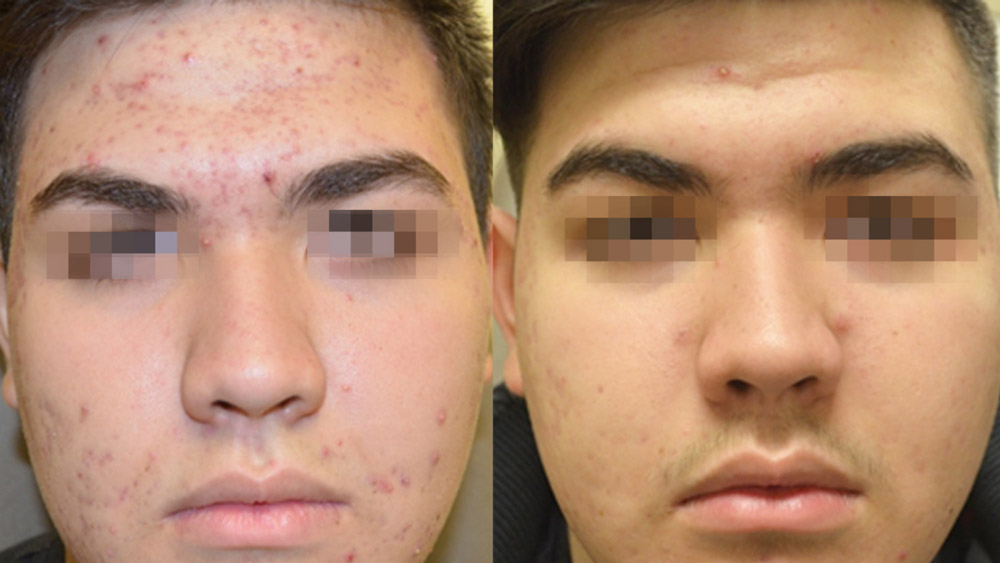 Before And After Morpheus8 Treatment On Male Patient With Acne Scars.