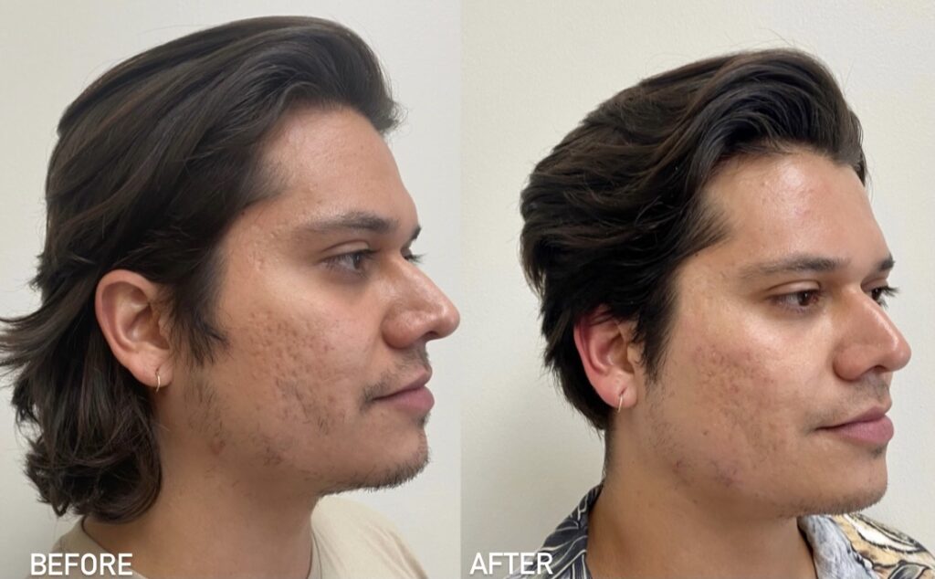 Male Patient'S Facial Transformation Before And After Morpheus8 Treatment.