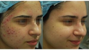 Before And After Morpheus8 Treatment For Acne Scars