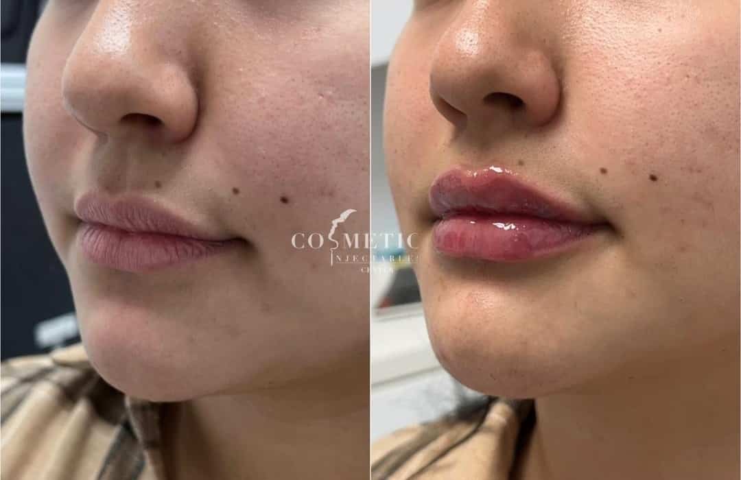 Before And After Results Of Botox Lip Flip Treatment