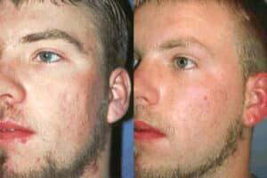 Bearded Man'S Facial Enhancement Before And After Morpheus8 Treatment.
