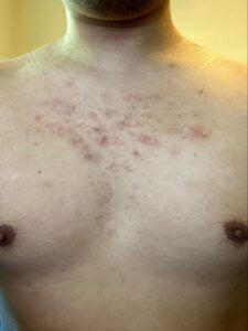 Close-Up Of Chest With Acne Breakouts