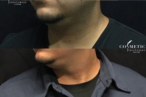 Kybella Treatment Results Before And After In Sherman Oaks