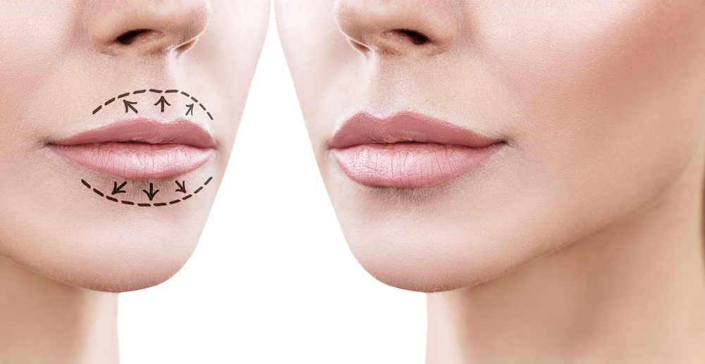 Before And After Comparison Of Lip Enhancement Demonstrating The Benefits Of Lip Fillers.