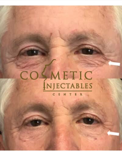 Visible Improvement In Under-Eye Area