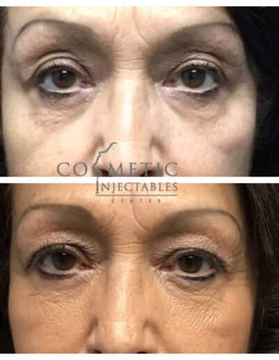 Closeup Undereye Injectables Result