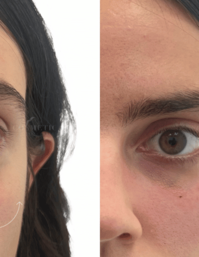 Cosmetic Injectable Effect On Eye Area.