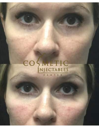 Visible Eye Rejuvenation Results From Cosmetic Injectables.