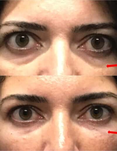 Eye Cosmetic Procedure Outcome Comparison