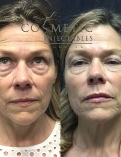 Detailed Eye Rejuvenation Therapy Results