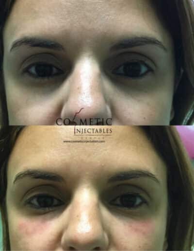Detailed Before And After Of Undereye Injectable