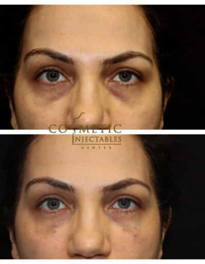 Successful Cosmetic Procedure For Eye Enhancement