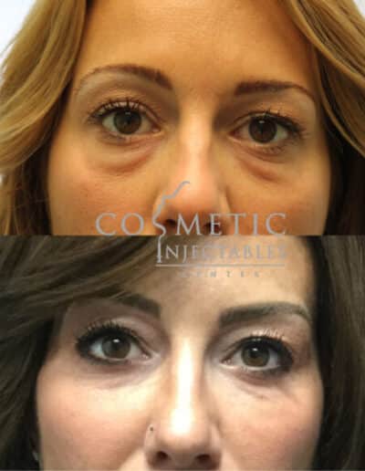 Before And After Eye Injectable Treatment Comparison