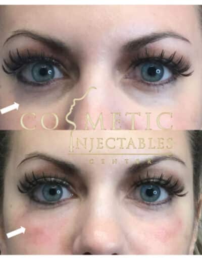 Eye Rejuvenation Cosmetic Therapy Progress