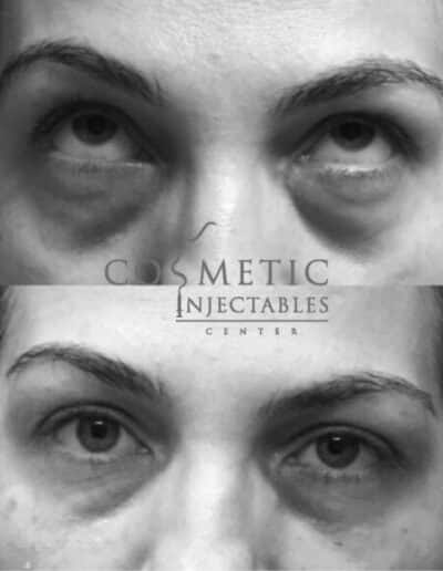 Eye Rejuvenation Results Cosmetic