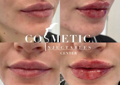 Before And After Photo Capturing The Successful Outcome Of Lip Filler Enhancements.