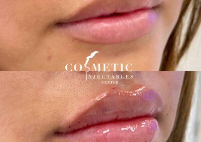 Lip Filler Transformation Before And After Result Of Patient
