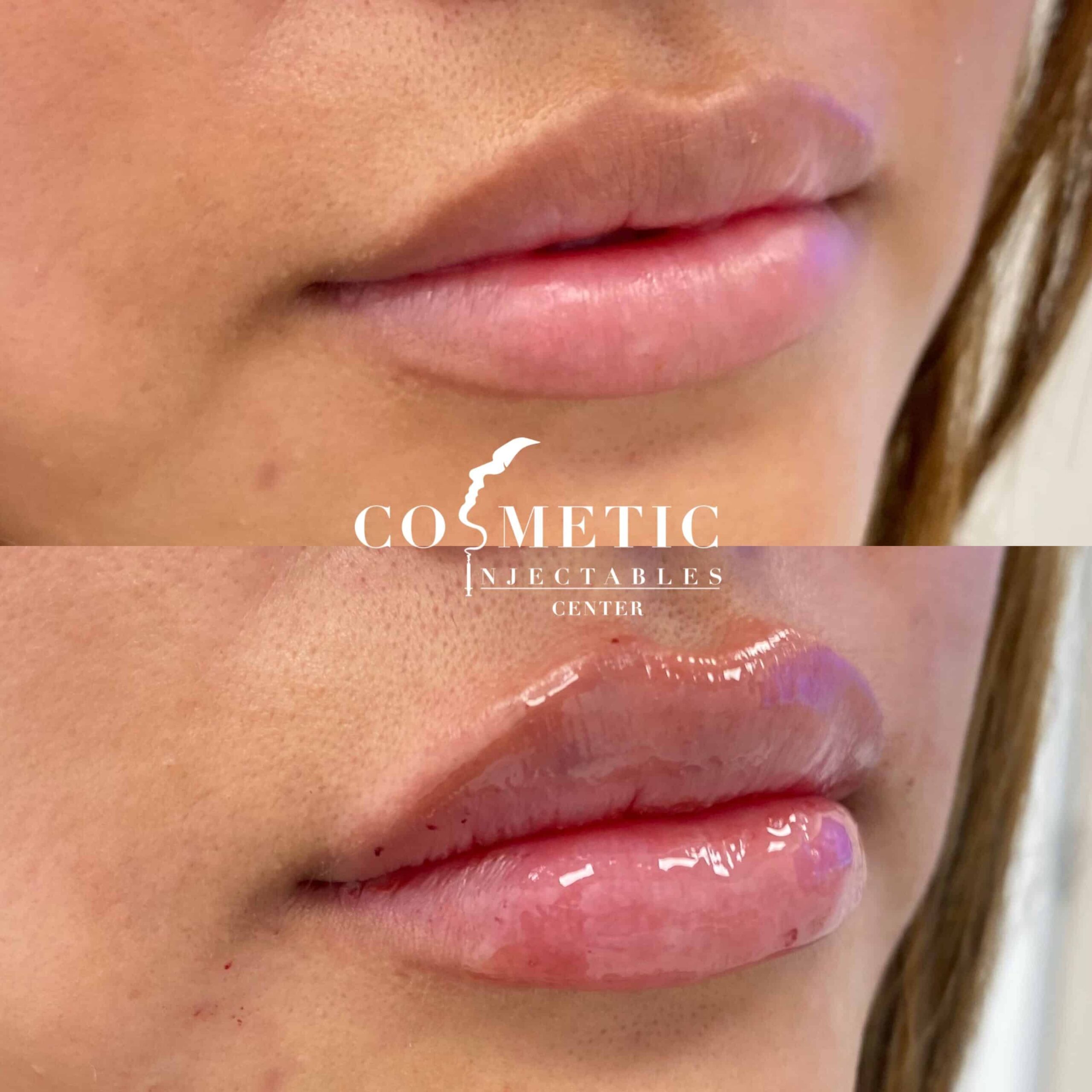 Before And After Comparison Highlighting The Volumizing Effects Of Professional Lip Filler Services.