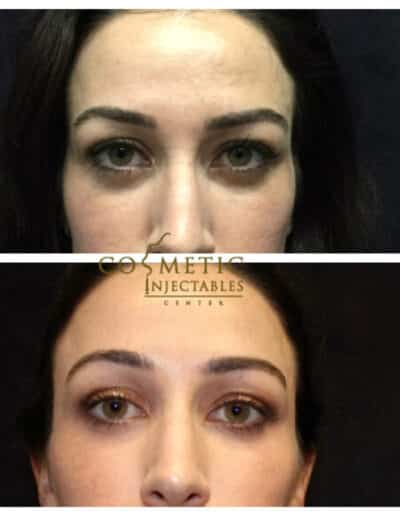 Notable Changes In Eye Appearance Post-Treatment