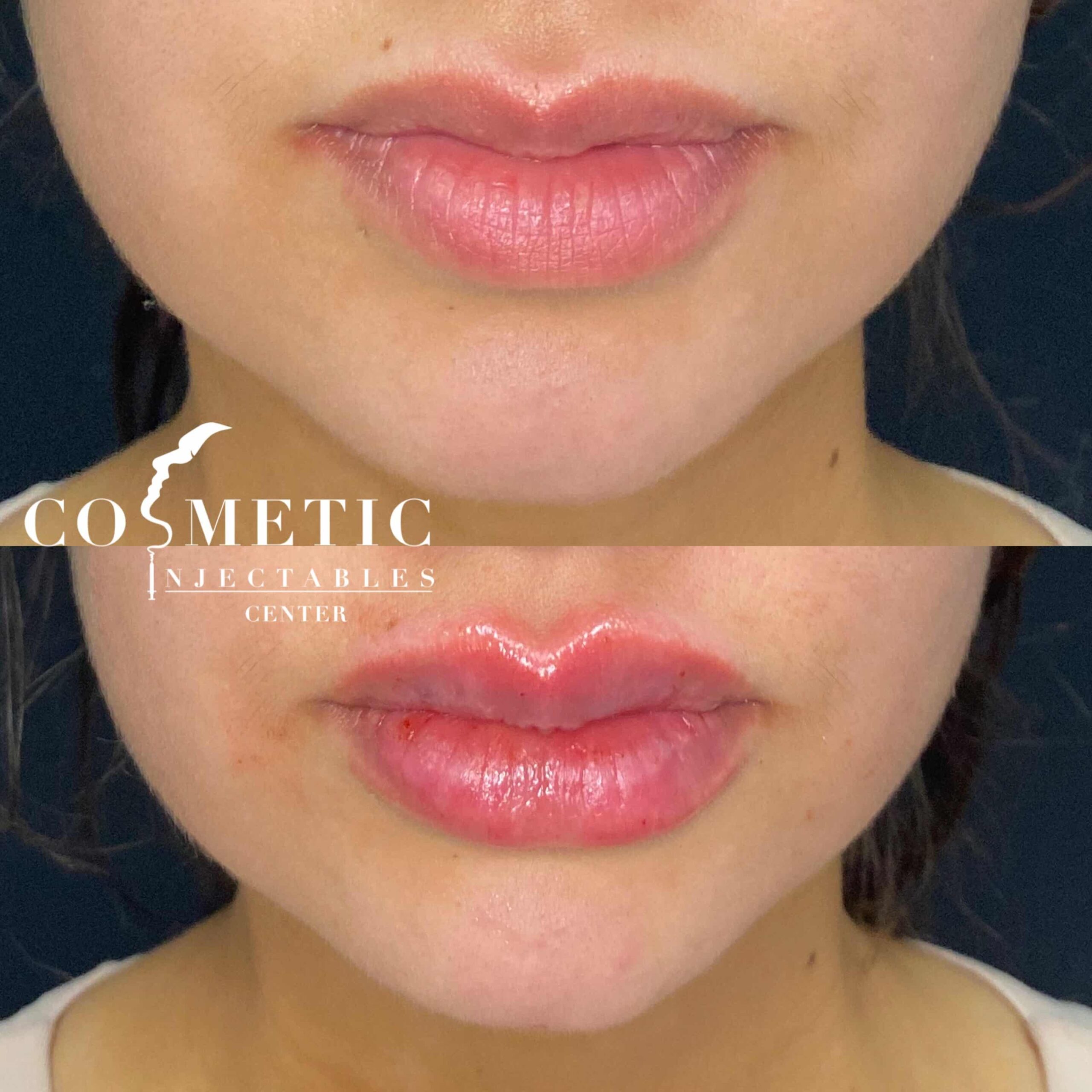 Before And After Lip Filler Effect On Patient, Highlighting The Enhancement In Lip Volume And Contour.