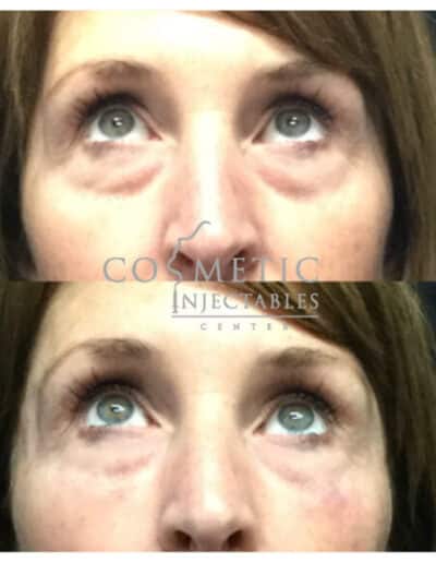 Reduced Eye Wrinkles Post Treatment