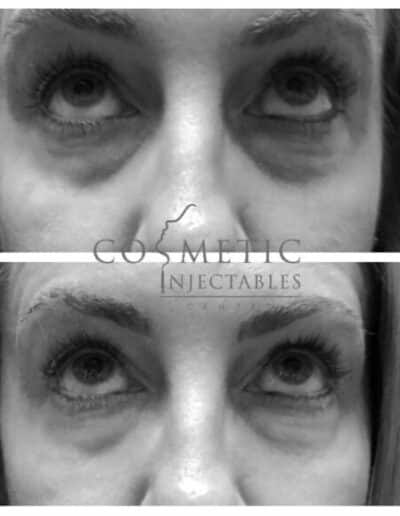 Refreshed And Youthful Eye Look After Cosmetic Procedure