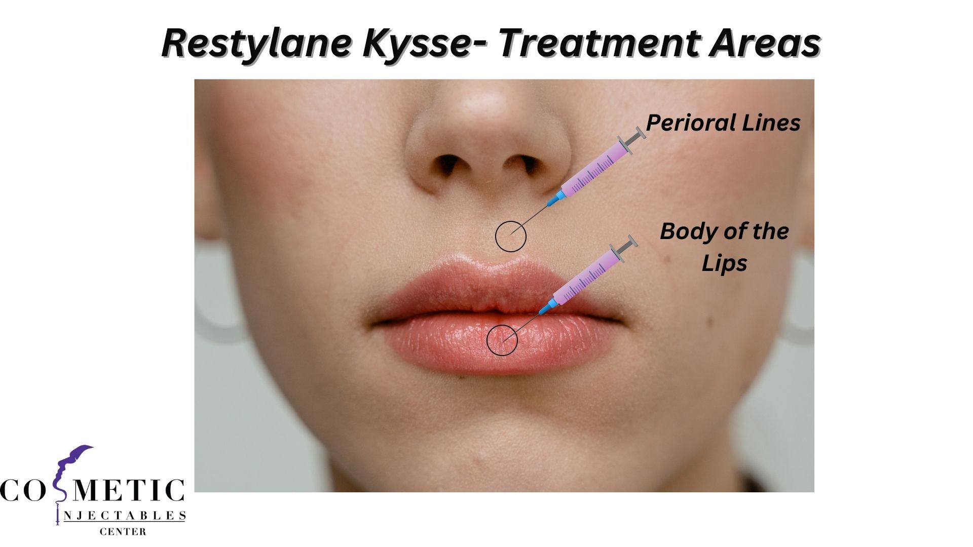 Detailed Illustration Of Restylane Kysse Injection Sites For Smoothing Perioral Lines.