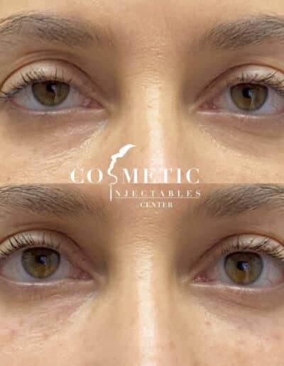Result Of Cosmetic Injectables On Undereye Area