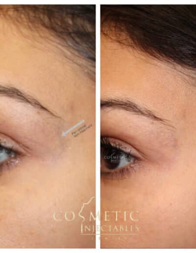Transformation Of Eyes Through Cosmetic Injectables