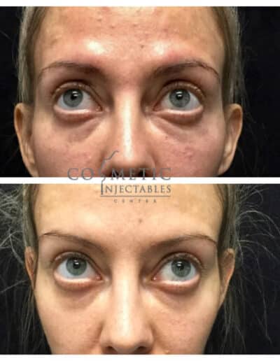 Before And After Showcasing Under-Eye Injectable Impact