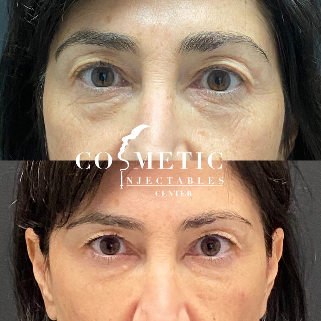 Before and after cosmetic undereye treatment