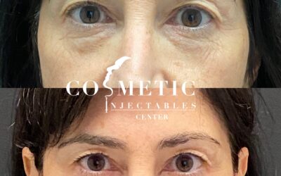 Under-Eye Hollows vs. Dark Circles: What’s Really Making You Look Tired?