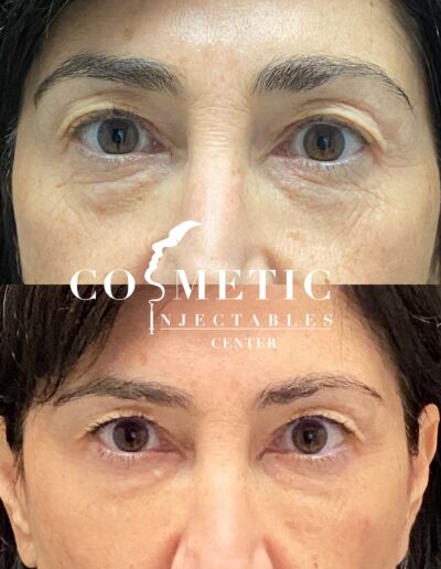 Before And After Cosmetic Undereye Treatment