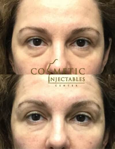 Result Of Undereye Rejuvenation Treatment