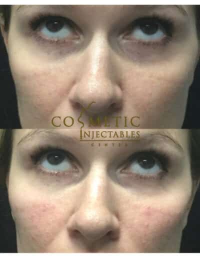 Visible Results Of Eye Area Cosmetic Injectables