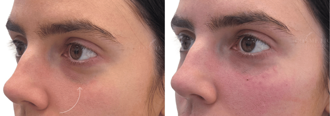 Youthful Look In Eye Area Post-Cosmetic Injectables.