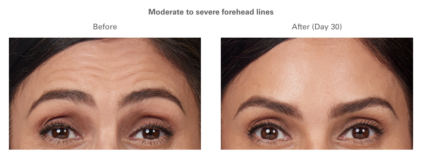 Botox Before And After To Female Patient Forehead Lines