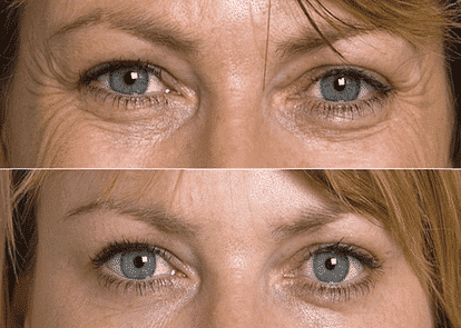 Https://Cosmeticinjectables.com/Wp-Content/Uploads/2023/12/Before-After-Eye-Rejuvenation-Treatment.png