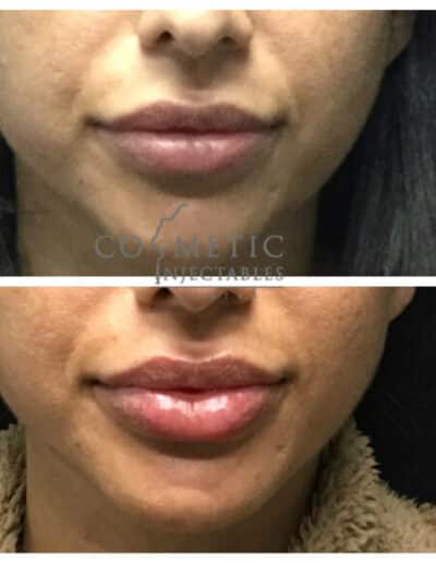 Natural Look Lip Enhancement Before And After Photos At A Cosmetic Injectables Center
