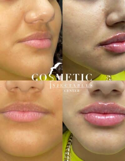 Detailed Before And After View Of Lip Fillers Procedure From A Cosmetic Injectables Center, Showcasing Patient Results