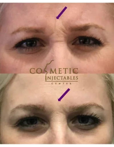 Blonde Woman Before And After Forehead And Frown Line Smoothing Treatment At Cosmetic Injectables Center