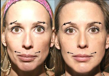 Before And After Cheek Enhancement To Correct Gaunt Facial Appearance