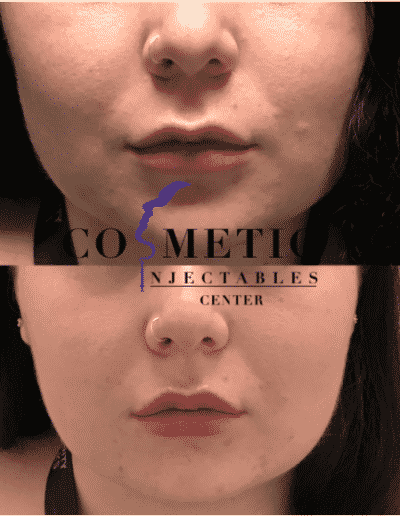 Close-Up View Of Before And After Facial Cosmetic Procedure, Displaying The Enhanced Lip Area At A Cosmetic Injectables Center