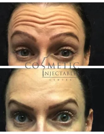 Before And After Comparison Of A Patient'S Forehead And Frown Line Cosmetic Treatment