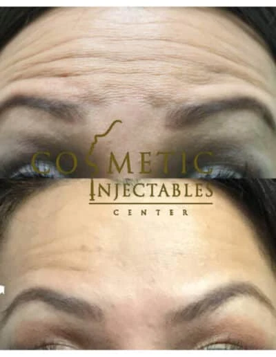 Before And After Results Of Forehead Frown Line Reduction By Cosmetic Injectables