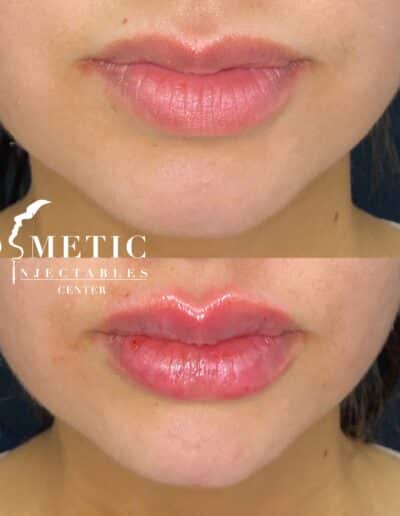 Before And After Showcase Of Cosmetic Lip Enhancement At A Specialized Injectables Center