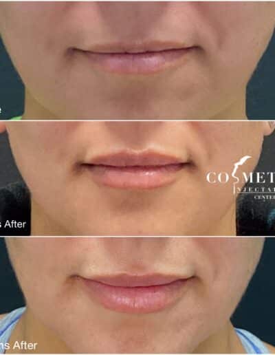 Comparative View Of Lips Before And After Cosmetic Filler Treatment.